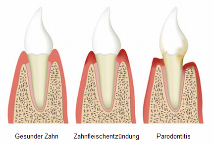 Gesunder Zahn - Zahnfleischentzündung - Parodontitis