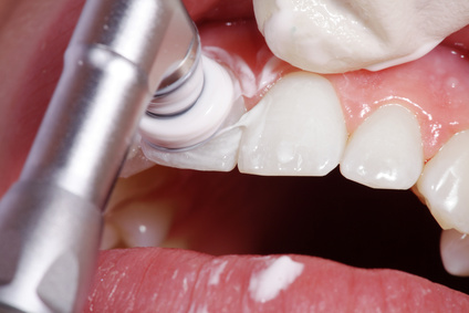 professionelle Zahnreinigung beim Zahnarzt